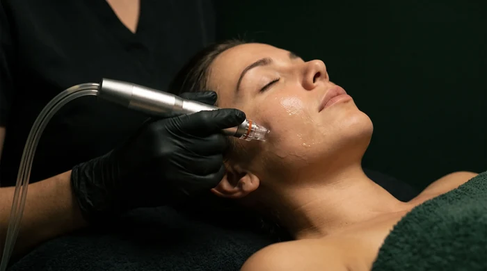 Korean Aqua Peel in progress at Altru Radiance in Murray, Utah — the hydradermabrasion handpiece and its clear spiral tip clearing the surface of the cheek